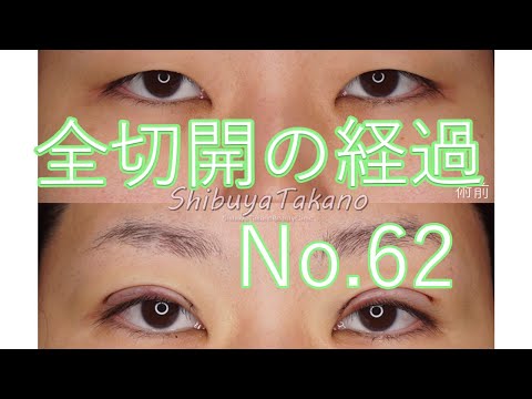 全切開二重　62　30代女性（＊1か月と3カ月が逆になっています!!!）