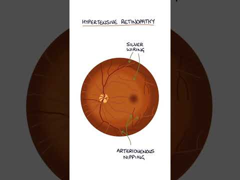 Hypertensive Retinopathy #medicine #medicalstudent #ophthalmology #optometrystudent