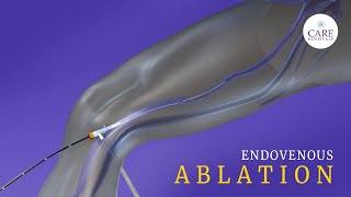 What is Endovenous Laser Ablation? CARE Hospitals