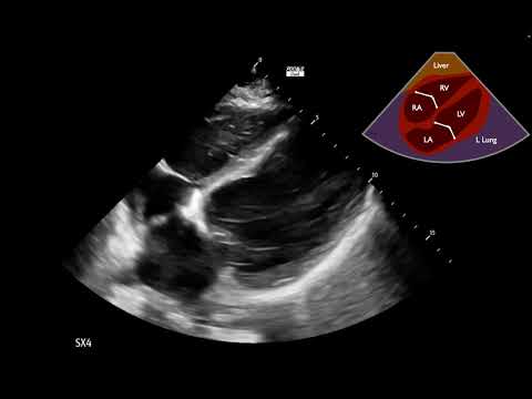 Cardiogenic Shock Case 2:  Part 2 - Explanation