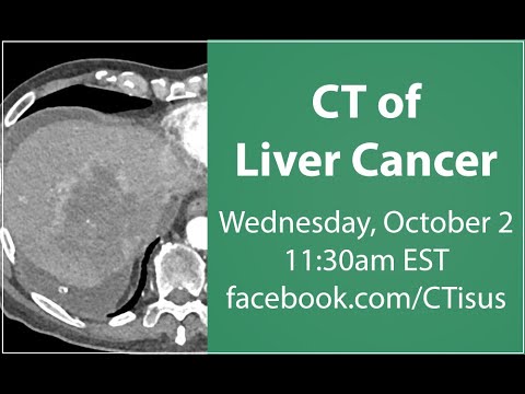 Facebook Live: CT of Liver Cancer