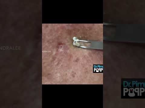 Dr Pimple Popper Goes Digging