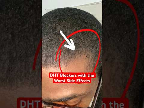 DHT Blockers! Watch out for these side effects. | Brotherly Hair Loss Tips (3/30)