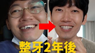 牙齒矯正2年後，最終效果到底怎麼樣？優缺點總結！feat. 牙套/整牙/隱適美｜大耳朵TV