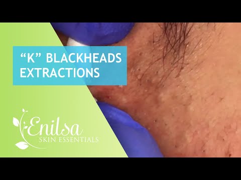 Blackheads Extractions “K’s” 2nd Treatment