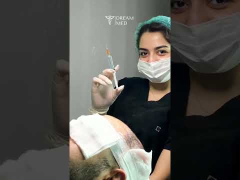 SAÇLARINIZI DREAM MED'İN UZMAN EKİBİNE BIRAKIN. #hairtransplant #saçekimi #dreammed