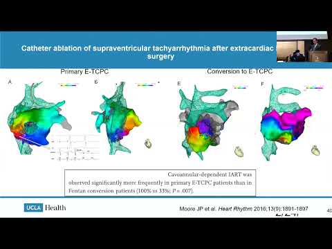 Arrhythmias and the Role of Electrical Interventions - Jeremy Moore, MD, MS