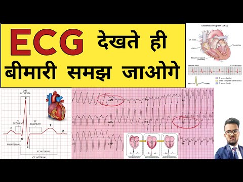 ECG Report | ECG Report Reading | ECG Report kaise Pade | Doctor | Hospital | Nursing | BHMS | BAMS