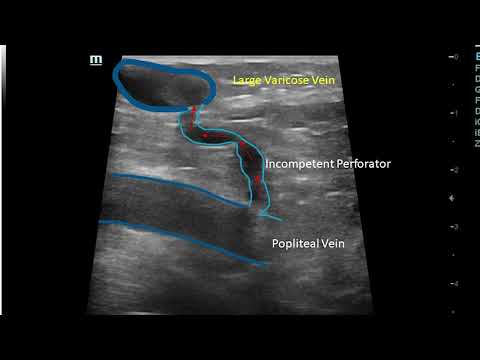 Large varicose vein due to incompetent perforator