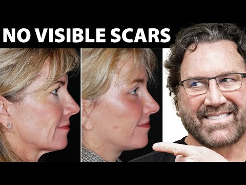 Facelift Technique You MUST Know About in 2024