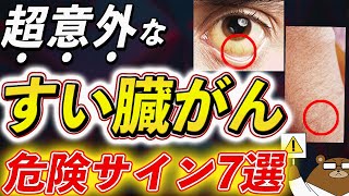 放置厳禁！知らないと後悔するすい臓がんの初期症状。尿、便、皮ふ、目..意外な兆候とは？予防法とは？医師が徹底解説。