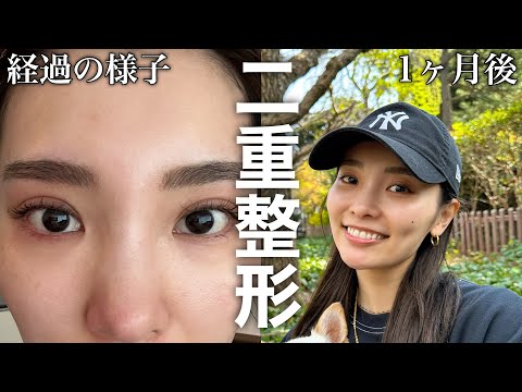 整形しました！整形するか悩んでいる人に伝えたい事！ #二重整形  #二重埋没