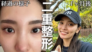 整形しました！整形するか悩んでいる人に伝えたい事！ #二重整形  #二重埋没