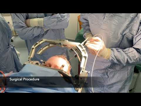 Stereotactic radiofrequency ventral posterolateral thalamotomy for cancer pain