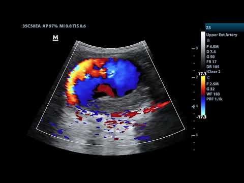 Giant pseudoaneurysm arising from branch of External Carotid Artery.