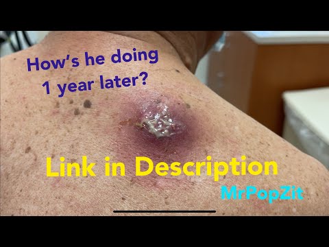 MrPopZit aka Greg Lynch Derm PA is going live! Giant abscess discussion!