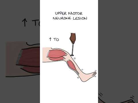 Upper Versus Lower Motor Neurone Lesions #neurology #medicine #clinicalexamination