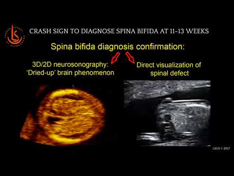 Crash Sign: Diagnosis of Spina Bifida at 11-13 weeks