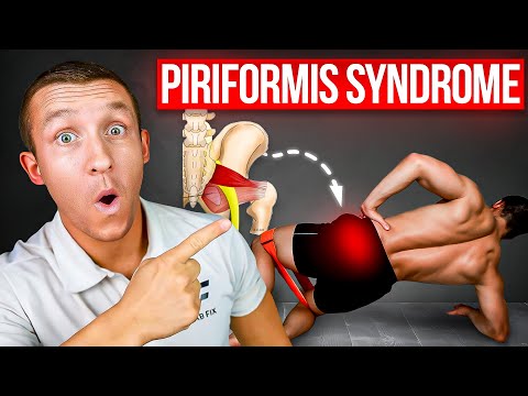 Piriformis Syndrome Relief: 4-Step Diagnosis & Top 5 Exercises + Live Case Study