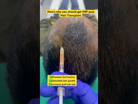 #hair #hairlosstreatment #alopecia #balding #hairtransplant #ytshorts #prp #shorts