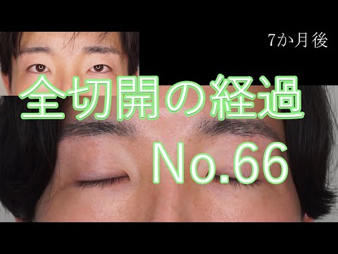 全切開66　幅を変えずにたるみを少し取って埋没法を切開法へ変更