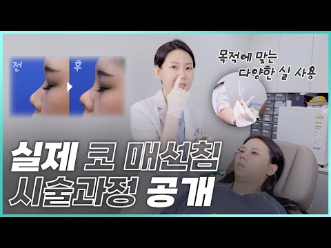 아름코 매선침(코실리프팅) 실제 비수술 시술과정 공개!