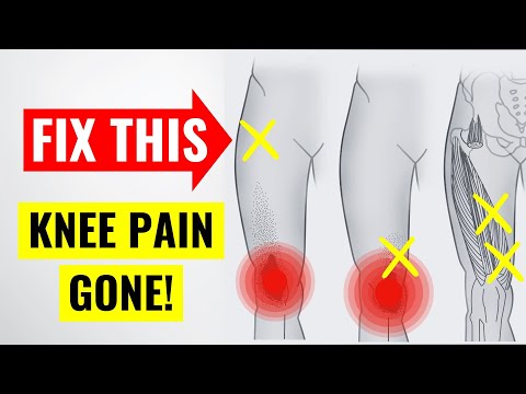 The #1 Hidden Cause of Chronic Knee Pain