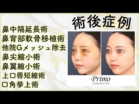 鼻中隔延長術　鼻と口元を整えてバランスの良いお顔に☆★美容整形・プリモ麻布十番クリニック☆★