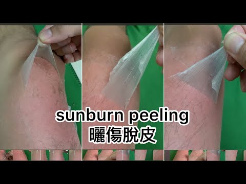 sunburn peeling🌞嚴重曬傷