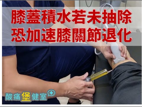 膝蓋受傷後 常導致膝關節積水!! 若你不知道這個治療方法 可能導致膝蓋加速退化!!!