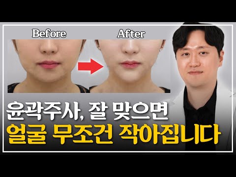 윤곽주사의 모든 것│효과, 원리, 부작용, 보톡스&리프팅과의 차이