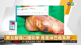 男左腳傷口腫如拳 竟是淋巴癌末期 | 華視新聞 20180816