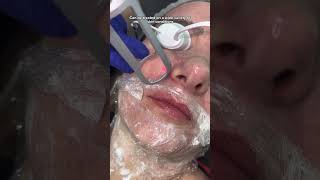 The Skin Renewal Facial with CO2 LASER | Dr. Medispa