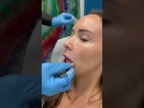 Transform Your Look: Amazing Swift Lip Filler Techniques at Plantation Med Spa, Florida #shorts