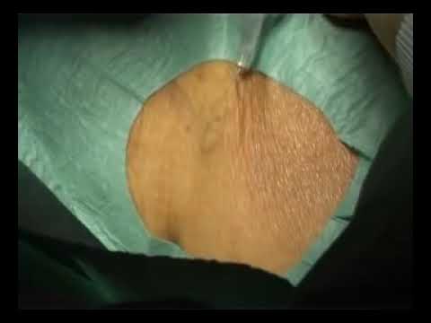 MedArt ILVO Procedure