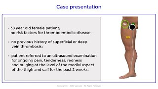 Thrombophlebitis of the great saphenous vein involving the common femoral vein