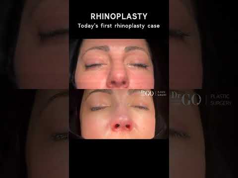 Patient Journey: Rhinoplasty Transformation 🌟