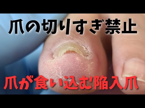 【深爪で爪が皮膚に食い込んだ陥入爪】山形県 寒河江巻き爪フットケアセンター　陥入爪、割れ爪も対応可能