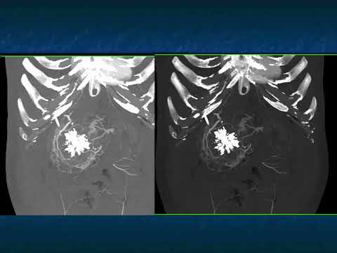 Cystic Pancreatic Lesions: Detection, Diagnosis and Management - Part 3