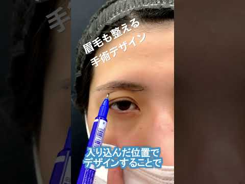 【眉の形はどうなる？】ジェントル式眉下リフトの手術デザインを公開します。