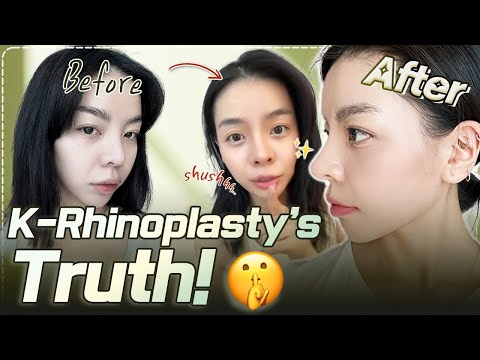 Can you believe it is my new nose...?😍| Nana's rhinoplasty at Braun PART 2 💖