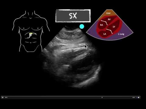 POCUS Teaching Point epicardial fat pad