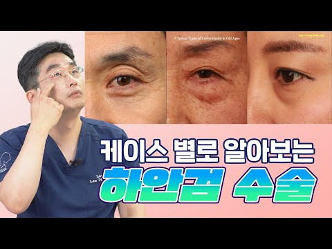 케이스별로 알아보는 하안검 수술