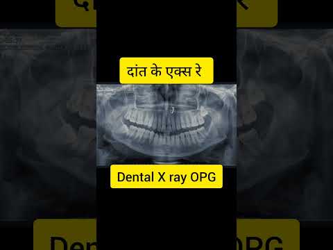 Dental X ray|OPG|