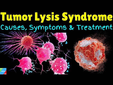 Tumor Lysis Syndrome (TLS): Causes, Symptoms, Diagnosis, Treatment and Prevention