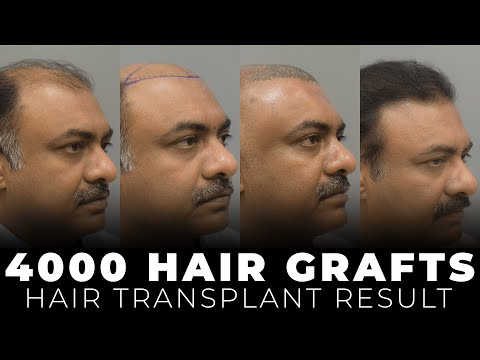 Shocking Transformation: Hair Transplant Before-After | Trichometric Sapphire FUE #caraclinic