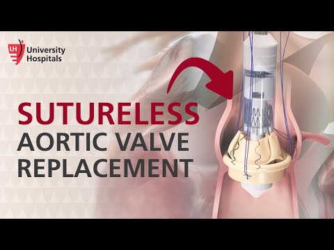 Heart Surgery: Perceval Sutureless Aortic Valve Replacement