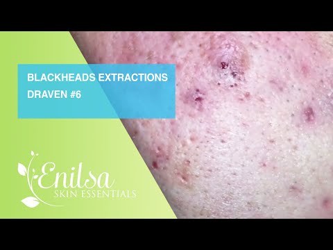 Blackheads Extractions Draven 6th Treatment