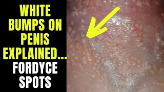 Doctor explains FORDYCE SPOTS / GRANULES - small white spots or pimples on the penis...