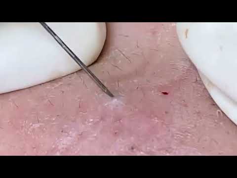 Popping huge blackheads and Pimple Popping - Best Pimple Popping Videos #433